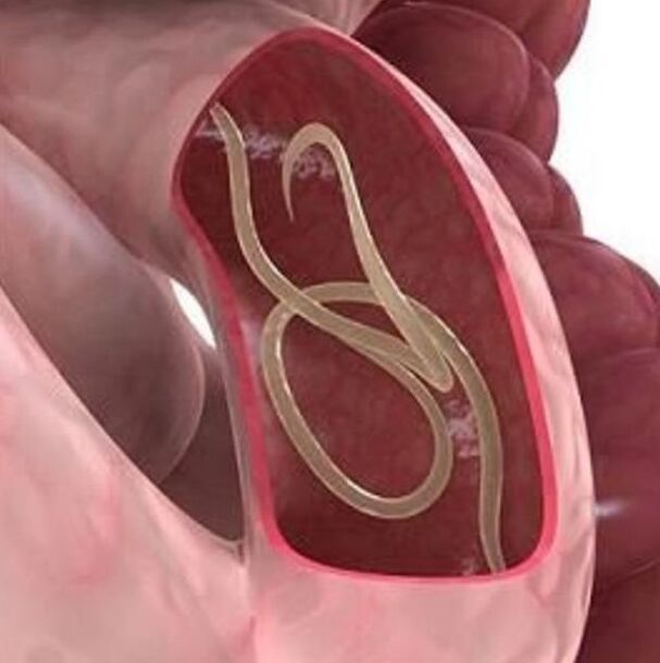 Známky červů u osoby v gastrointestinálním traktu
